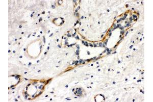 Anti- YES1 Picoband antibody,IHC(P) IHC(P): Human Mammary Cancer Tissue (YES1 anticorps  (N-Term))