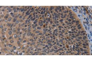 Immunohistochemistry of paraffin-embedded Human cervical cancer using P2RX2 Polyclonal Antibody at dilution of 1:50 (P2RX2 anticorps)