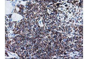 Immunohistochemical staining of paraffin-embedded Adenocarcinoma of Human breast tissue using anti-ALDH3A2 mouse monoclonal antibody. (ALDH3A2 anticorps)