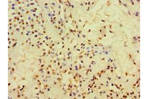 Immunohistochemistry of paraffin-embedded human breast cancer using ABIN7148384 at dilution of 1:100 (Adipsin anticorps  (AA 26-253))