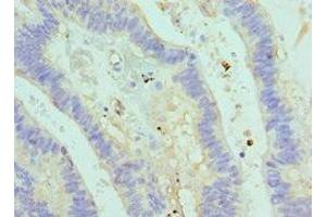 Immunohistochemistry of paraffin-embedded human colon cancer using ABIN7160711 at dilution of 1:100 (ASMTL anticorps  (AA 1-290))