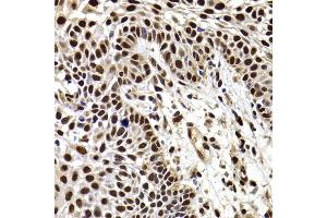 Immunohistochemistry of paraffin-embedded human well-differentiated squamous skin carcinoma using HIRIP3 antibody (ABIN6128019, ABIN6141779, ABIN6141780 and ABIN6222788) at dilution of 1:100 (40x lens). (HIRIP3 anticorps  (AA 417-556))