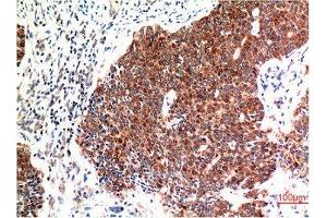 Immunohistochemical analysis of paraffin-embedded Human Breast Carcinoma Tissue using Beclin-1 Mouse mAb diluted at 1:200.