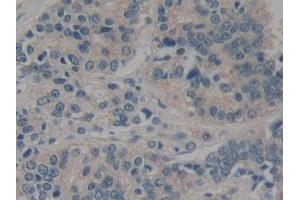 Detection of CARD9 in Human Prostate cancer Tissue using Polyclonal Antibody to Caspase Recruitment Domain Family, Member 9 (CARD9)