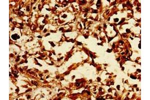 Immunohistochemistry of paraffin-embedded human melanoma using ABIN7147471 at dilution of 1:100 (LASS5 anticorps  (AA 332-392))