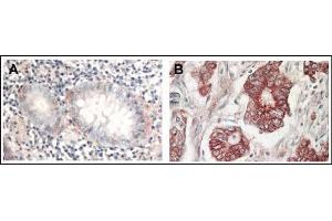 AP22624PU-N AKT antibody staining of Formalin-Fixed Paraffin-Embedded Sections at 1/1,000 dilution: Panel A: Normal colon tissue Panel B: Tumor tissue. (AKT1 anticorps  (C-Term))
