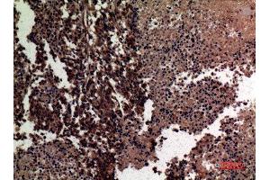 Immunohistochemistry (IHC) analysis of paraffin-embedded Human Lung Cancer, antibody was diluted at 1:100. (MMP12 anticorps  (Internal Region))