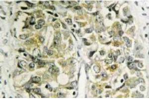 Immunohistochemistry (IHC) analyzes of Galectin-8 antibody in paraffin-embedded human prostate carcinoma tissue. (LGALS8 anticorps)