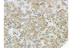 ABIN6265851 and ABIN6278192 at 1/100 staining human renal cell carcinoma by IHC-P. (UBE2L6 anticorps  (C-Term))