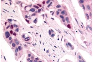 Anti-CDK12 / CRKRS antibody  ABIN1048422 IHC staining of human breast carcinoma. (CDK12 anticorps  (Internal Region))
