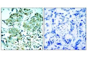 Immunohistochemical analysis of paraffin-embedded human breast carcinoma tissue, using (EGFR anticorps)