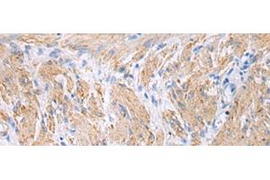 Immunohistochemistry of paraffin-embedded Human gastric cancer tissue using FBXO45 Polyclonal Antibody at dilution of 1:40(x200) (FBXO45 anticorps)