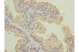 Immunohistochemistry of paraffin-embedded human prostate cancer using ABIN7157360 at dilution of 1:100 (Keratin 33B anticorps  (AA 1-404))