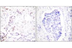 Immunohistochemistry analysis of paraffin-embedded human breast carcinoma tissue, using Cyclin A1 Antibody. (Cyclin A1 anticorps  (AA 411-460))