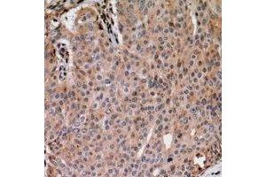 Immunohistochemical analysis of ANAPC1 (pS688) staining in human breast cancer formalin fixed paraffin embedded tissue section. (APC1 anticorps  (pSer688))