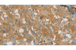 Immunohistochemistry of paraffin-embedded Human breast cancer using PLPP1 Polyclonal Antibody at dilution of 1:40 (PLPP1 anticorps)
