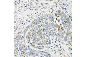 Immunohistochemistry of paraffin-embedded human esophageal cancer using SH2B1 Antibody (ABIN1876744) at dilution of 1:100 (40x lens). (SH2B1 anticorps)