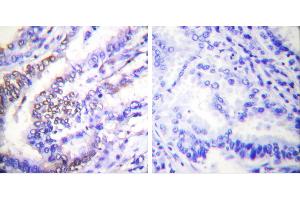Peptide - +Immunohistochemical analysis of paraffin-embedded human lung carcinoma tissue using Cyclinantibody. (Cyclin E1 anticorps)