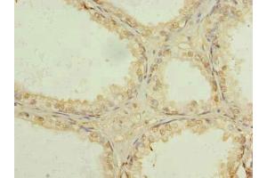 Immunohistochemistry of paraffin-embedded human prostate cancer using ABIN7174340 at dilution of 1:100 (USP47 anticorps  (AA 1-157))