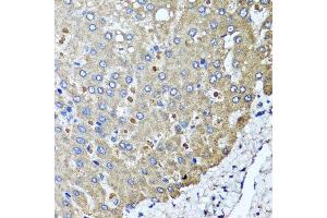 Immunohistochemistry of paraffin-embedded human colon carcinoma using PPOX antibody at dilution of 1:100 (x40 lens). (PPOX anticorps)