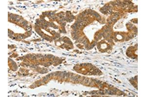The image on the left is immunohistochemistry of paraffin-embedded Human colon cancer tissue using ABIN7131078(SLC12A1 Antibody) at dilution 1/15, on the right is treated with fusion protein. (SLC12A1 anticorps)