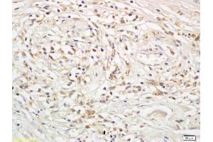 Formalin-fixed and paraffin embedded human rectal cancer labeled with Anti-Snail/SNAI 1 Polyclonal Antibody, Unconjugated (ABIN685597) followed by conjugation to the secondary antibody and DAB staining (SNAI1, SNAI2, SNAI3 (AA 188-264) anticorps)