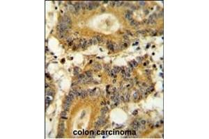 RPS6KA1 Antibody (ABIN654115 and ABIN2843994) immunohistochemistry analysis in formalin fixed and paraffin embedded human colon carcinoma followed by peroxidase conjugation of the secondary antibody and DAB staining. (RPS6KA1 anticorps)