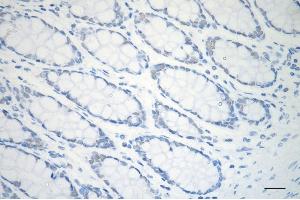Immunohistochemistry was performed on paraffin-embedded human sigmoid colon carcinoma using ARID1A antibody (ABIN7797666), 1:200). (Recombinant ARID1A anticorps)