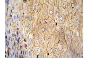 Beta-Actin antibody immunohistochemistry analysis in formalin fixed and paraffin embedded human esophageal carcinoma.