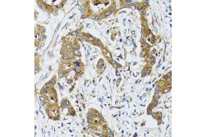 Immunohistochemistry of paraffin-embedded human colon carcinoma using BLZF1 antibody (ABIN2561429) at dilution of 1:100 (40x lens). (BLZF1 anticorps)