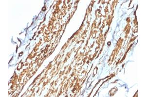 Formalin-fixed, paraffin-embedded human Testicular Carcinoma stained with VCL Mouse Monoclonal Antibody (VCL/2575). (Vinculin anticorps  (AA 174-322))