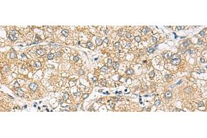 Immunohistochemistry of paraffin-embedded Human liver cancer tissue using DACT3 Polyclonal Antibody at dilution of 1:70(x200) (DACT3 anticorps)