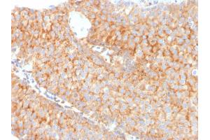 Formalin-fixed, paraffin-embedded human Urothelial Carcinoma stained with PAI-RBP1 Mouse Monoclonal Antibody (SERBP1/3491).