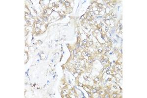 Immunohistochemistry of paraffin-embedded human liver cancer using Smad7 antibody (ABIN7270356) at dilution of 1:100 (40x lens). (SMAD7 anticorps  (AA 1-100))