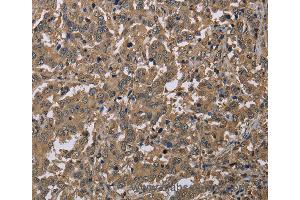 Immunohistochemistry of Human liver cancer using CAB39 Polyclonal Antibody at dilution of 1:40 (CAB39 anticorps)
