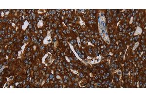 Immunohistochemistry of paraffin-embedded Human ovarian cancer tissue using KISS1R Polyclonal Antibody at dilution 1:30 (KISS1R anticorps)