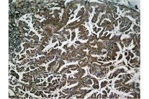 Immunohistochemical analysis of paraffin-embedded human Lung carcinoma tissue using NFκB-p65 (Phospho-Ser536) Antibody.