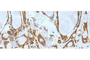 Immunohistochemistry of paraffin-embedded Human thyroid cancer tissue using TSGA10 Polyclonal Antibody at dilution of 1:50(x200)