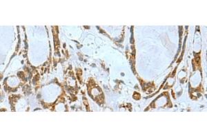 Immunohistochemistry of paraffin-embedded Human thyroid cancer tissue using TSGA10 Polyclonal Antibody at dilution of 1:50(x200) (TSGA10 anticorps)