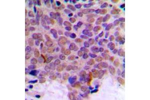 Immunohistochemical analysis of CLK1 staining in human breast cancer formalin fixed paraffin embedded tissue section.