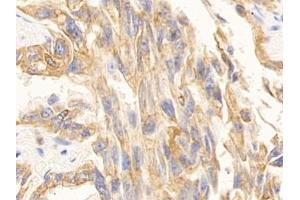 Detection of CK10 in Human Lung cancer Tissue using Polyclonal Antibody to Cytokeratin 10 (CK10)