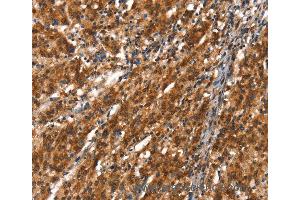 Immunohistochemistry of Human thyroid cancer using CYP2D6 Polyclonal Antibody at dilution of 1:40 (CYP2D6 anticorps)