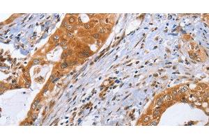Immunohistochemistry of paraffin-embedded Human cervical cancer using CDK19 Polyclonal Antibody at dilution of 1:70 (CDK19 anticorps)