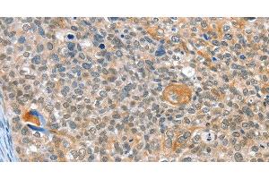 Immunohistochemistry of paraffin-embedded Human cervical cancer using ALDOB Polyclonal Antibody at dilution of 1:40