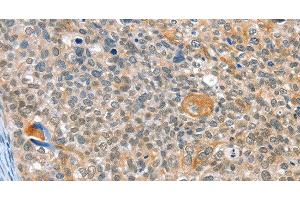 Immunohistochemistry of paraffin-embedded Human cervical cancer using ALDOB Polyclonal Antibody at dilution of 1:40 (ALDOB anticorps)