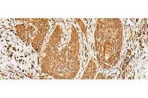 Immunohistochemistry of paraffin-embedded Human esophagus cancer tissue using PPOX Polyclonal Antibody at dilution of 1:30(x200) (PPOX anticorps)