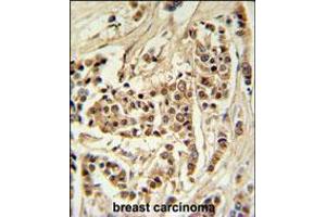 TTPAL Antibody IHC analysis in formalin fixed and paraffin embedded human breast carcinoma followed by peroxidase conjugation of the secondary antibody and DAB staining. (TTPAL anticorps  (C-Term))
