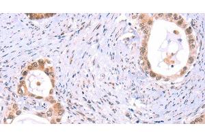 Immunohistochemistry of paraffin-embedded Human cervical cancer tissue using PROS1 Polyclonal Antibody at dilution 1:60 (PROS1 anticorps)