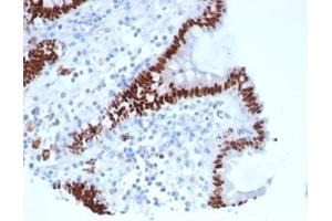 Formalin-fixed, paraffin-embedded human colon carcinoma stained with CDX2 Recombinant Mouse Monoclonal Antibody (rCDX2/6921).