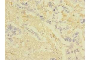 Immunohistochemistry of paraffin-embedded human pancreatic cancer using ABIN7147896 at dilution of 1:100 (Claudin 18 anticorps  (AA 20-80))